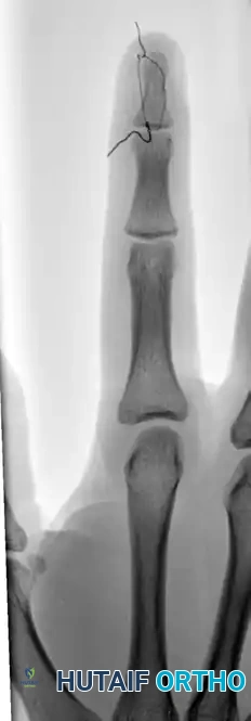 OPEN REDUCTION AND FIXATION WITH A KIRSCHNER WIRE Surgical Diagram