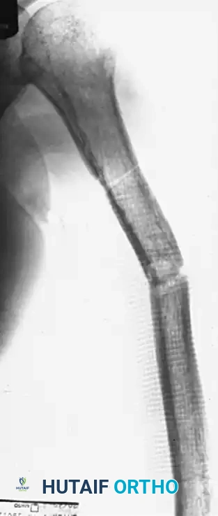 Comprehensive Management of Humeral Nonunions and Prosthetic Reconstruction