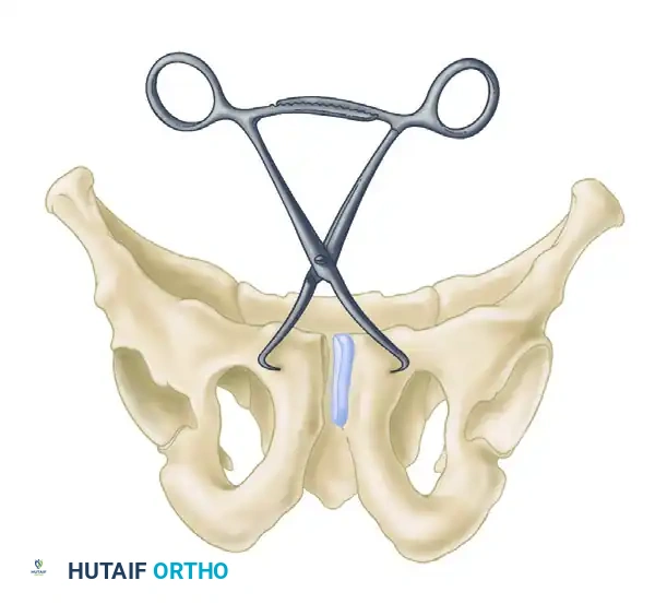 Open Reduction and Internal Fixation of the Pubic Symphysis and Pelvic Ring