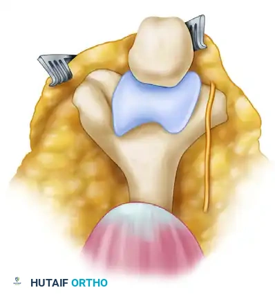 Triceps split technique