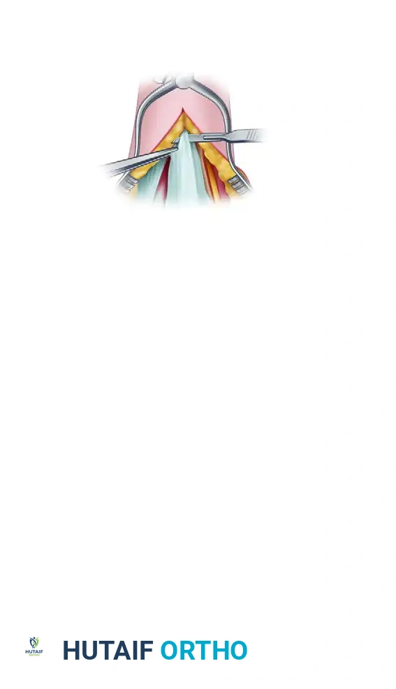 Split extended to transcutaneous border