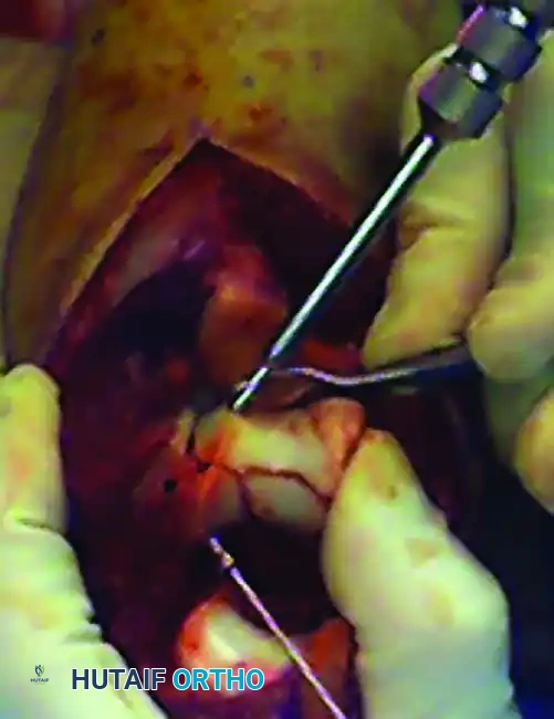 Olecranon osteotomy marked
