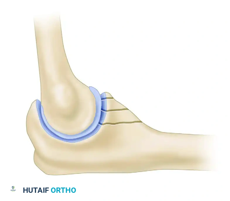 Open Reduction and Internal Fixation of Radial Head Fractures: A Comprehensive Surgical Guide