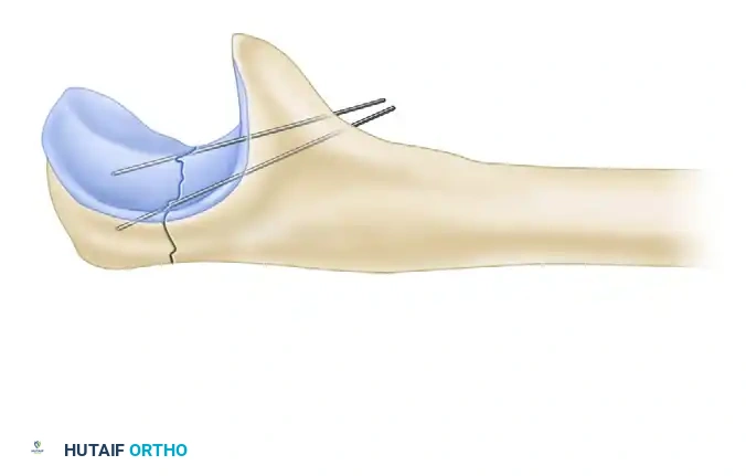 Operative Management of Complex Forearm and Elbow Fractures