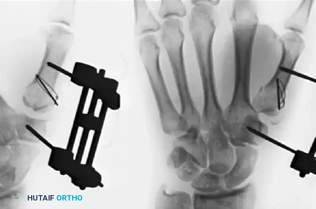 OPEN REDUCTION AND INTERNAL FIXATION Surgical Diagram