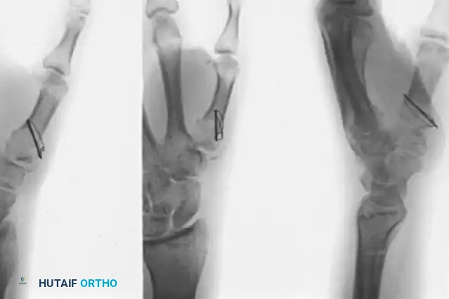 Open Reduction and Internal Fixation of Thumb Metacarpal Base Fractures