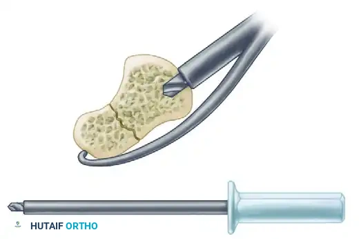 Jig used for volar approach to scaphoid