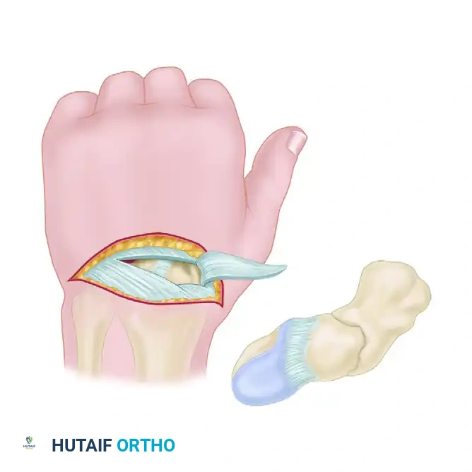 OPEN REDUCTION AND INTERNAL FIXATION OF ACUTE DISPLACED FRACTURES OF THE SCAPHOID— DORSAL APPROACH Surgical Diagram
