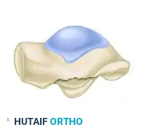 OPEN REDUCTION AND INTERNAL FIXATION OF FRACTURES OF THE LATERAL PROCESS OF THE TALUS Surgical Diagram