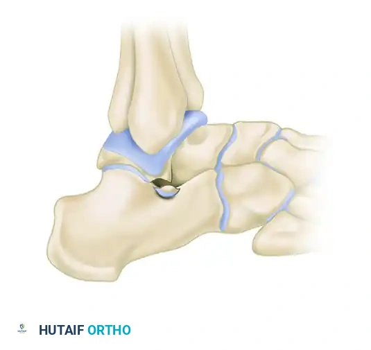OPEN REDUCTION AND INTERNAL FIXATION OF FRACTURES OF THE LATERAL PROCESS OF THE TALUS Surgical Diagram