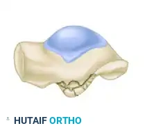 OPEN REDUCTION AND INTERNAL FIXATION OF FRACTURES OF THE LATERAL PROCESS OF THE TALUS Surgical Diagram