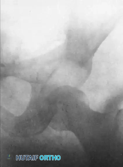 Management of Chronic Unreduced Hip Dislocations