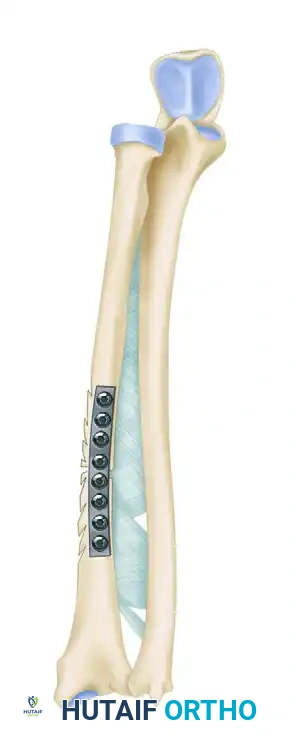 Comprehensive Surgical Management of Upper Extremity Nonunions: Humeral Condyle and Forearm Reconstruction