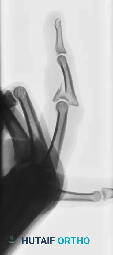 OPEN REDUCTION— NONCOMMINUTED Surgical Diagram