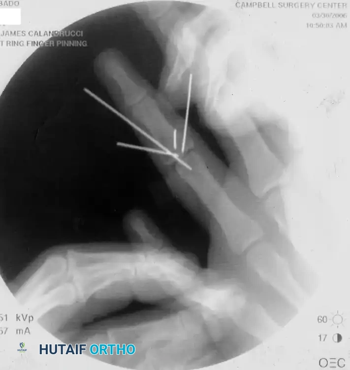 OPEN REDUCTION— NONCOMMINUTED Surgical Diagram