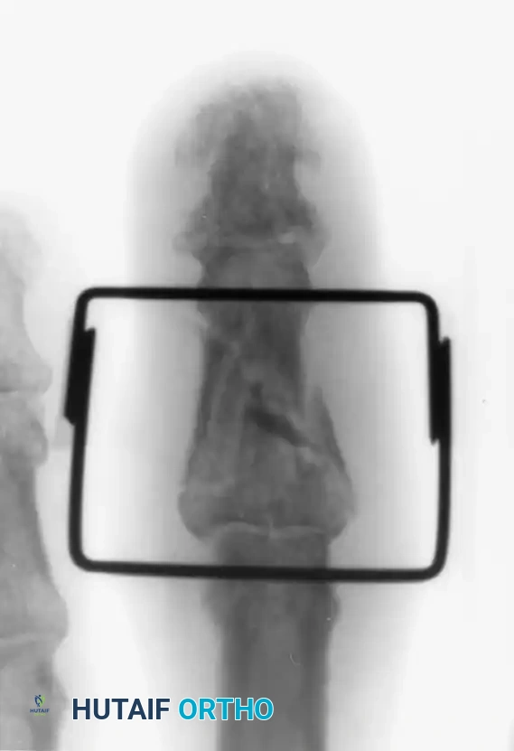 OPEN REDUCTION— NONCOMMINUTED Surgical Diagram