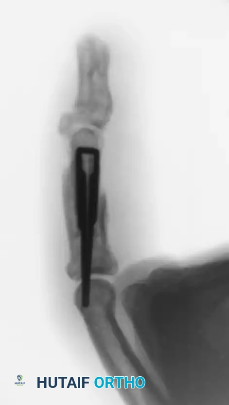 OPEN REDUCTION— NONCOMMINUTED Surgical Diagram