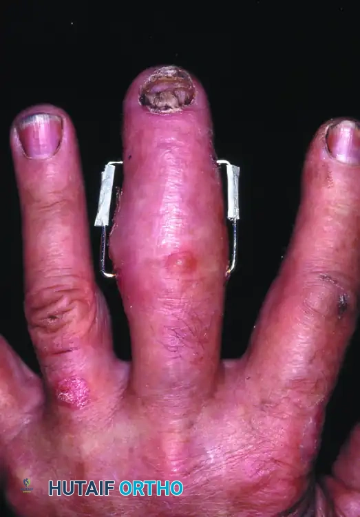 OPEN REDUCTION— NONCOMMINUTED Surgical Diagram