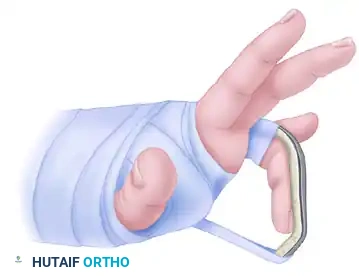 OPEN REDUCTION— NONCOMMINUTED Surgical Diagram