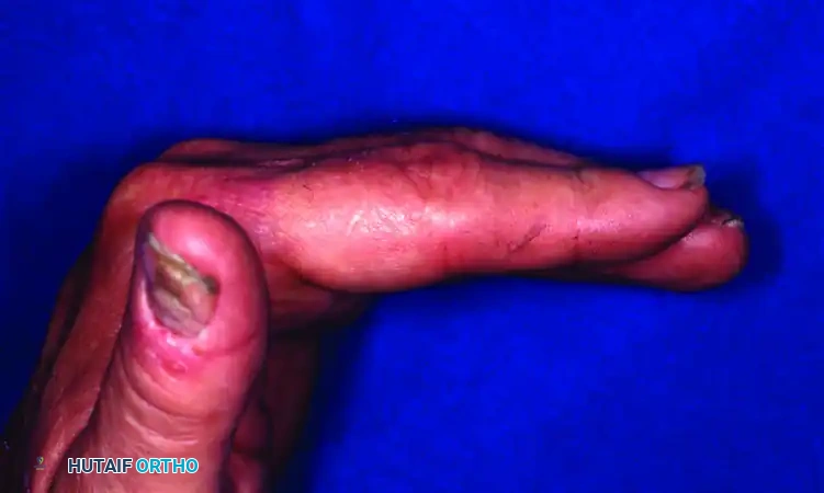 OPEN REDUCTION— NONCOMMINUTED Surgical Diagram