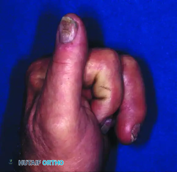 OPEN REDUCTION— NONCOMMINUTED Surgical Diagram