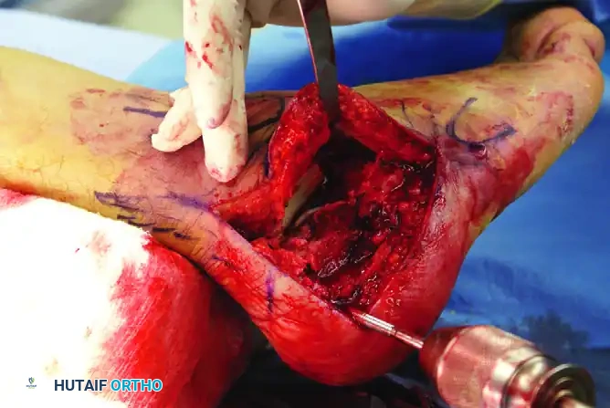 OPEN REDUCTION OF CALCANEAL FRACTURE Surgical Diagram