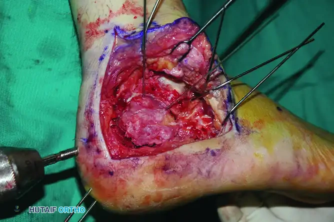 OPEN REDUCTION OF CALCANEAL FRACTURE Surgical Diagram