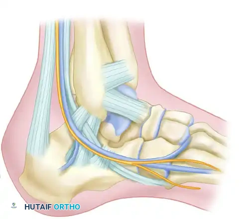 OPEN REDUCTION OF CALCANEAL FRACTURE Surgical Diagram