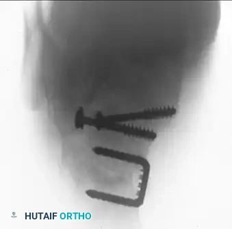 OPEN REDUCTION OF CALCANEAL FRACTURE: MEDIAL AND LATERAL APPROACHES Surgical Diagram