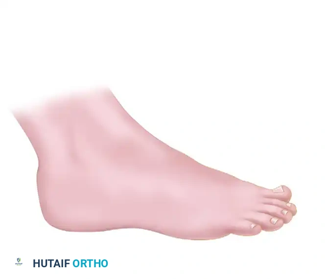 OPEN REDUCTION OF CALCANEAL FRACTURE: MEDIAL AND LATERAL APPROACHES Surgical Diagram