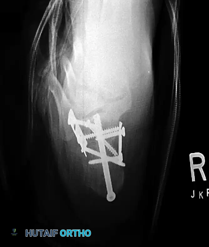 OPEN REDUCTION OF CALCANEAL FRACTURE: MEDIAL AND LATERAL APPROACHES Surgical Diagram