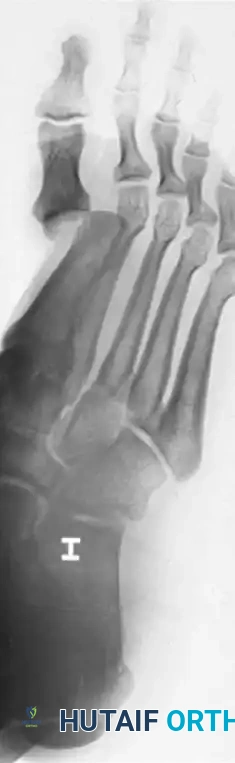 OPEN REDUCTION OF DISLOCATION OF THE INTERPHALANGEAL JOINTS OF THE HALLUX Surgical Diagram