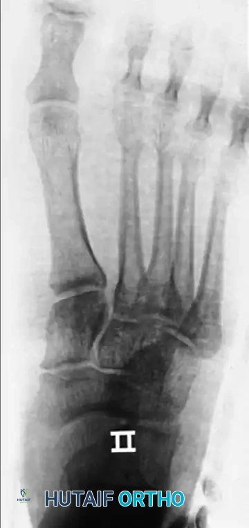 OPEN REDUCTION OF DISLOCATION OF THE INTERPHALANGEAL JOINTS OF THE HALLUX Surgical Diagram
