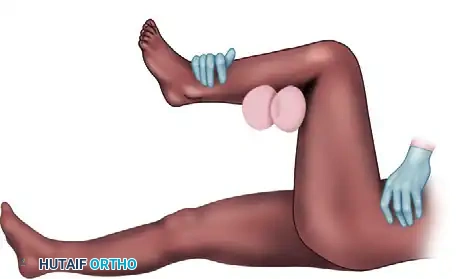OPEN REDUCTION OF HIP DISLOCATION Surgical Diagram