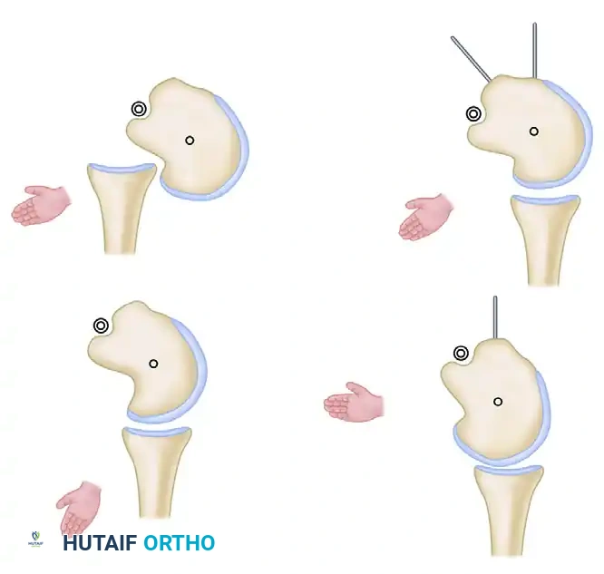 Diagrammatic representation of principle of rotational osteotomy in shoulder with locked posterior shoulder dislocation.
