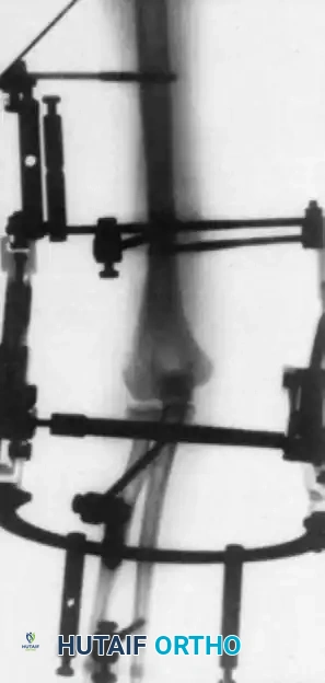 FIGURE 61-24 Anteroposterior radiograph showing lateral dislocation of the elbow and horn of ossification.