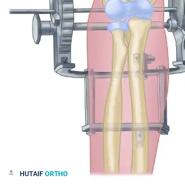 Reconstruction Step 6