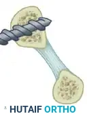 Reconstruction Step 2