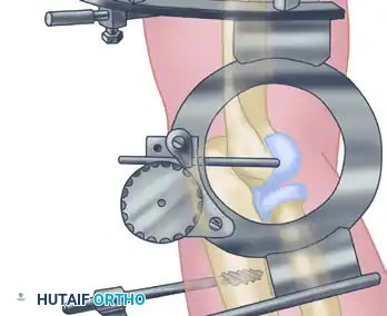 Reconstruction Step 9