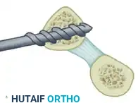 Reconstruction Step 1