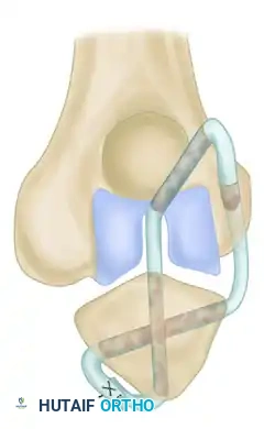 OPEN REDUCTION Surgical Diagram D