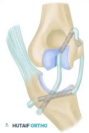 OPEN REDUCTION Surgical Diagram C