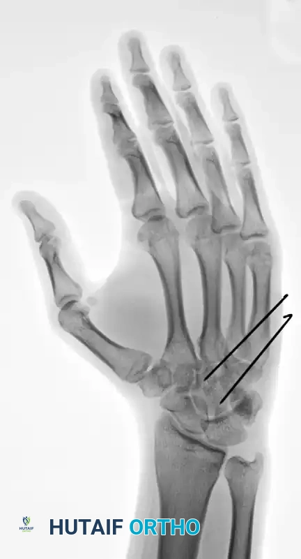 OPEN REDUCTION Surgical Diagram