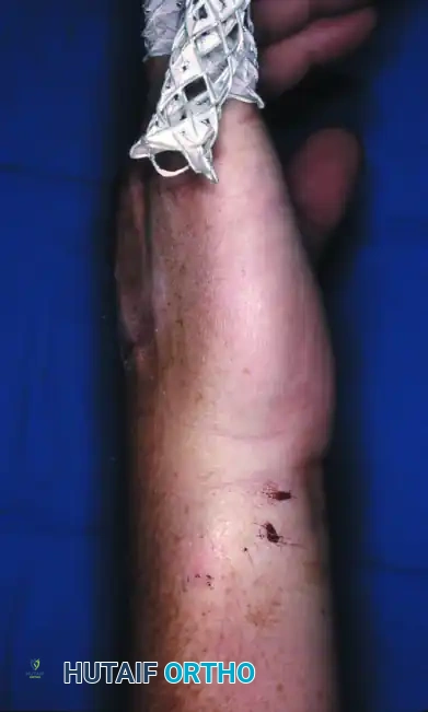 OPEN REDUCTION Surgical Diagram