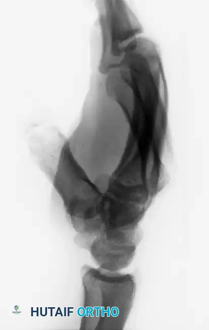 OPEN REDUCTION Surgical Diagram