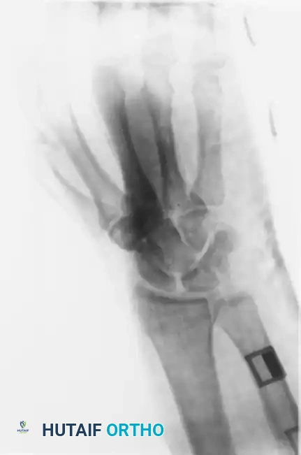 OPEN REDUCTION Surgical Diagram