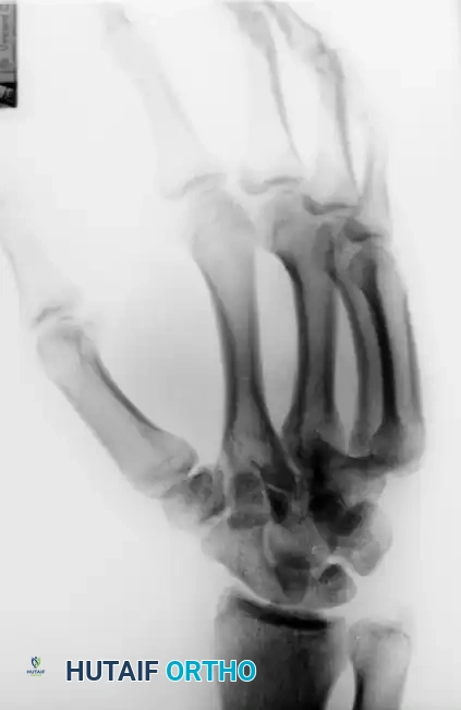 OPEN REDUCTION Surgical Diagram