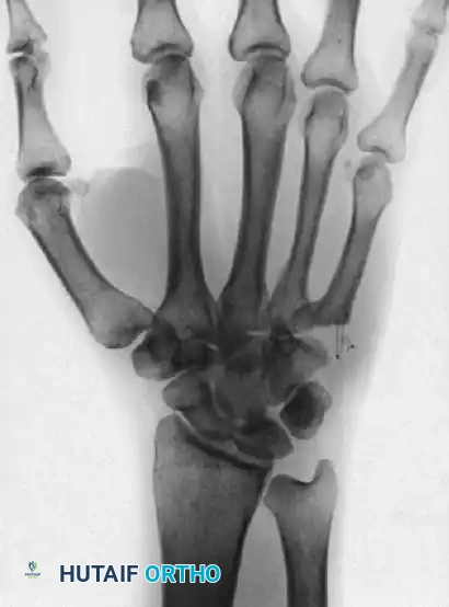 OPEN REDUCTION Surgical Diagram