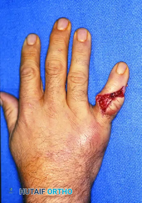 Mastering Open Reduction and Internal Fixation of Phalangeal Fractures and PIP Joint Dislocations