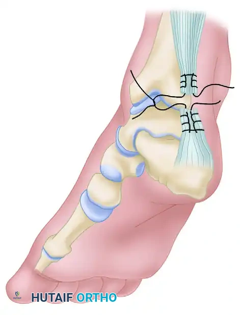 FIGURE 48-16 Lindholm technique for repairing ruptures of Achilles tendon. SEE TECHNIQUE 48-9.